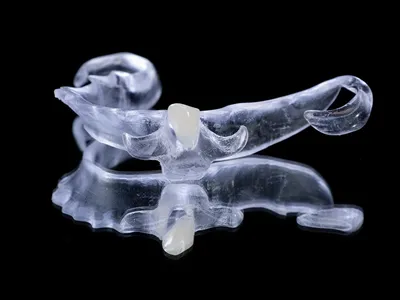 Essix Retainer
