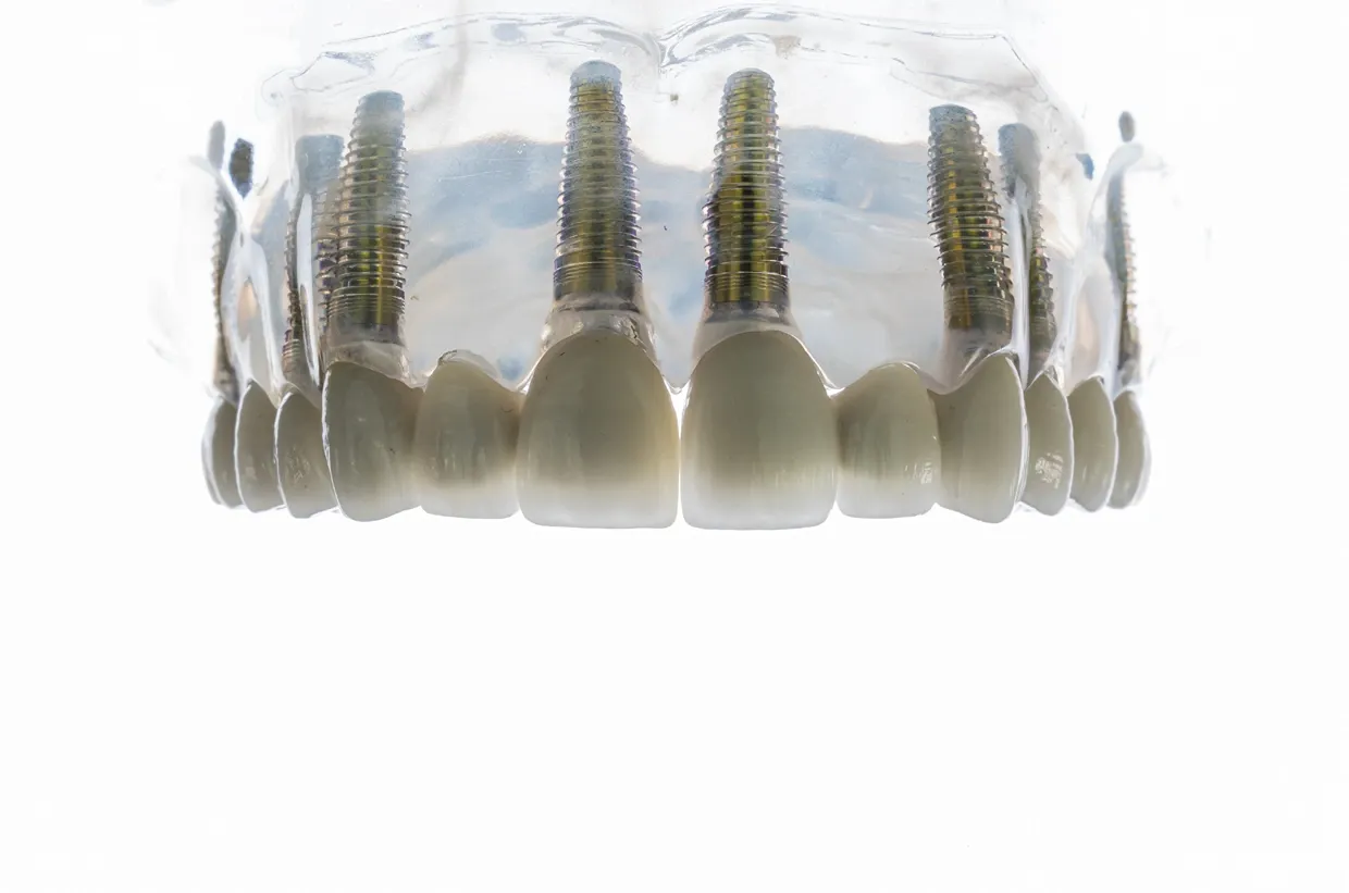 Implant Supported Bridges