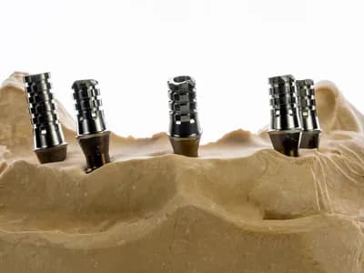 Custom Implant Abutments