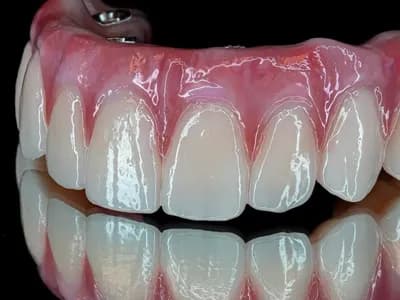 All-on-X Hybrid (acrylic/titanium)