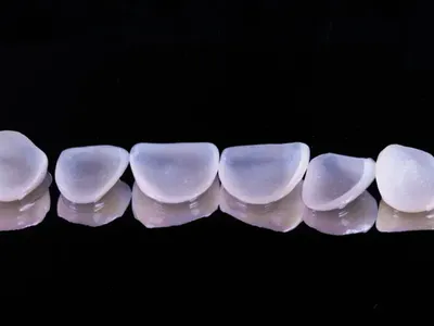Hand-Layered Porcelain Veneers