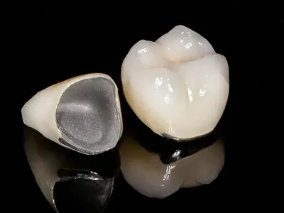 Porcelain-Fused-to-Metal Crown