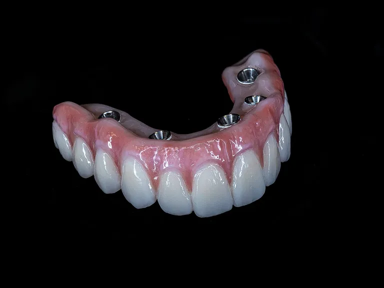 Acrylic All-on-X With Titanium Bar