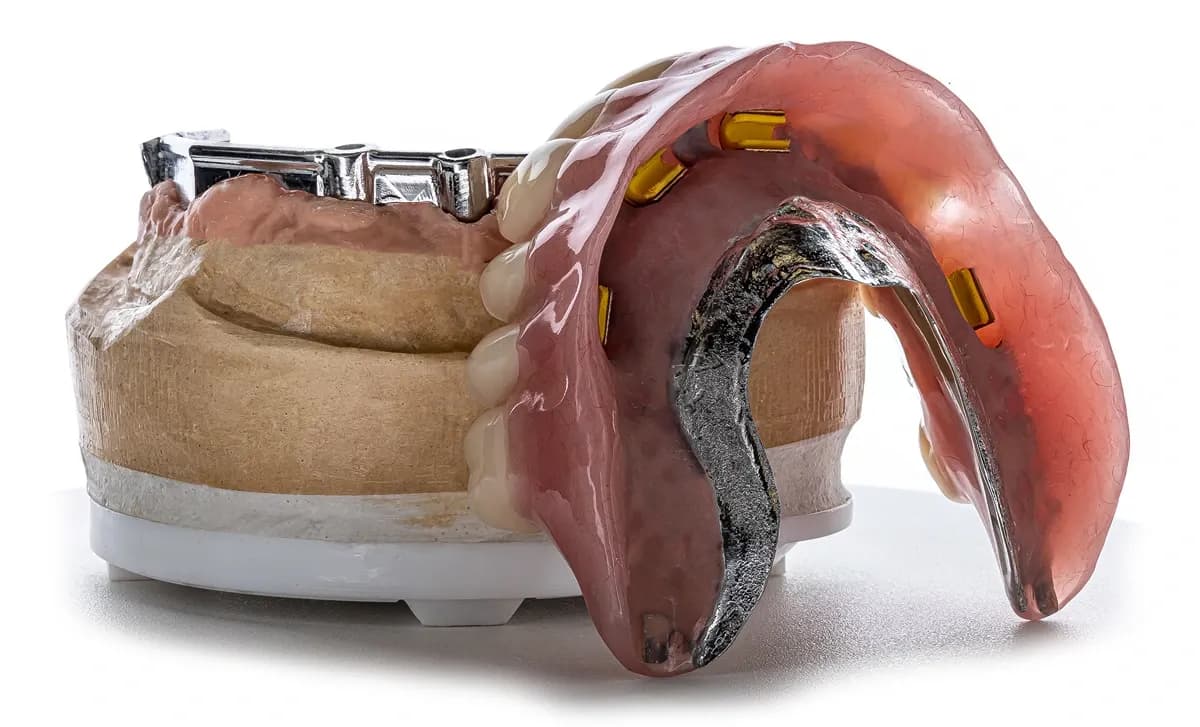 Hader Bar Overdenture
