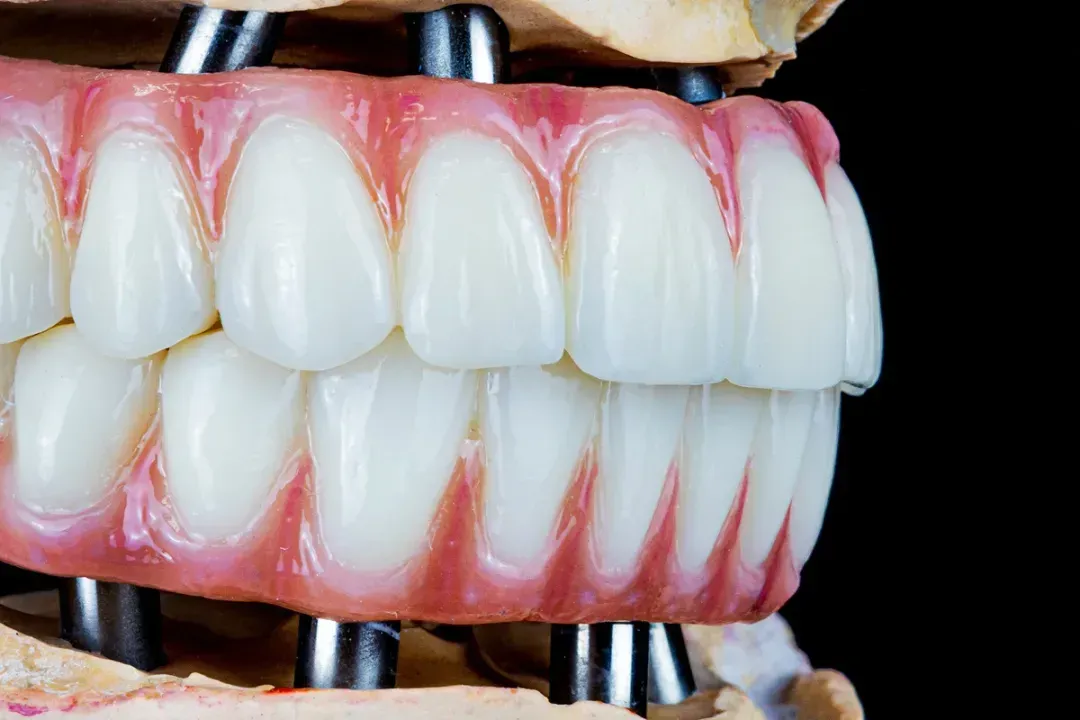 All-on-X Zirconia