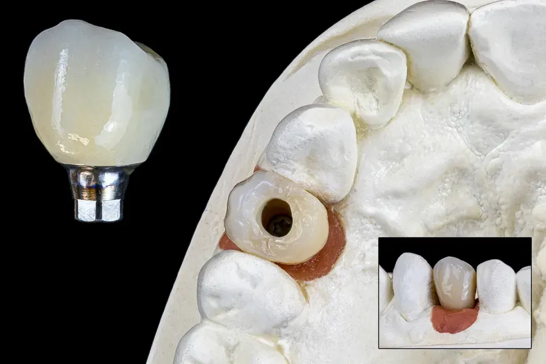Implant Solutions