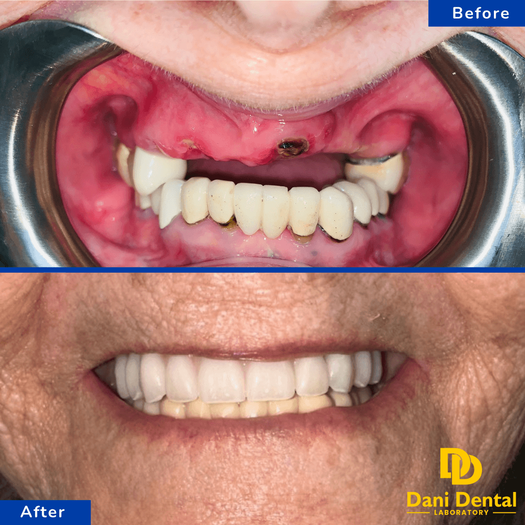 All On X Zirconia