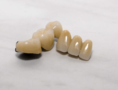 Giving Your Patients More Choices for Dental Crowns and Bridges